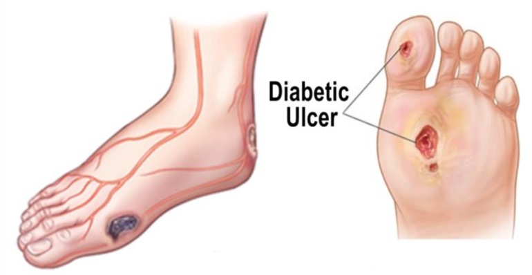 Şeker Hastalarındaki Ayak Yaraları (Diyabetik Ayak) Neden Önemlidir?